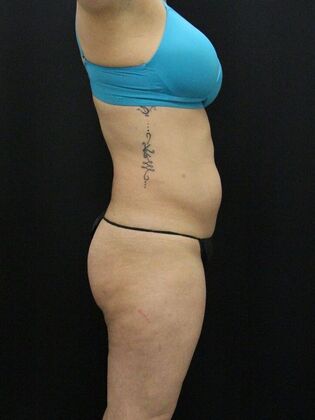 Liposuction: Case 13 - Before