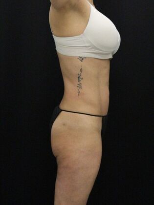 Liposuction: Case 13 - After