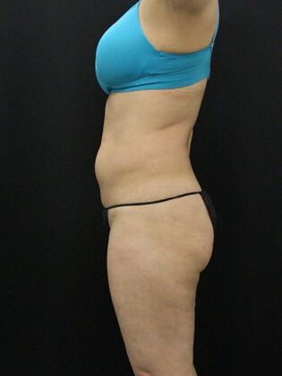 Liposuction: Case 13 - Before