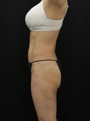 Liposuction: Case 13 - After