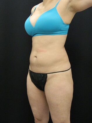 Liposuction: Case 13 - Before