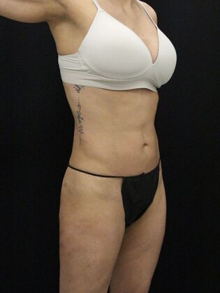 Liposuction: Case 13 - After