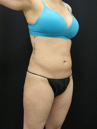 Liposuction: Case 13 - Before