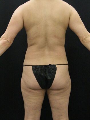 Liposuction: Case 13 - Before