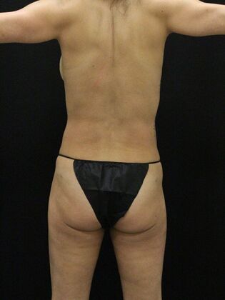 Liposuction: Case 13 - After