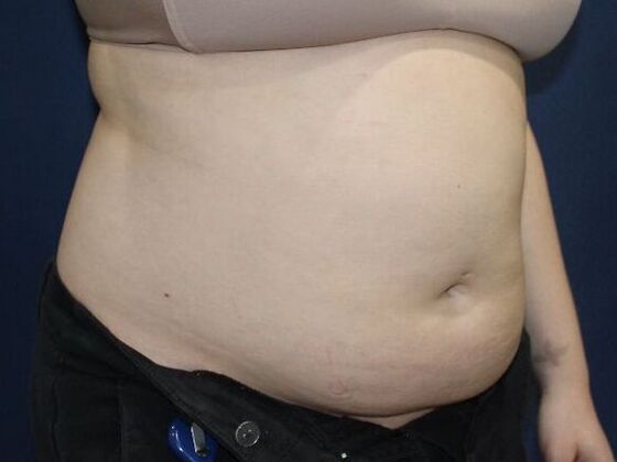 Liposuction: Case 14 - Before