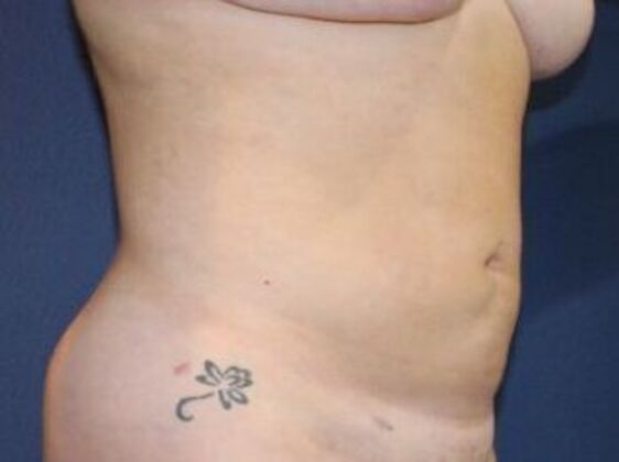 Liposuction: Case 14 - After