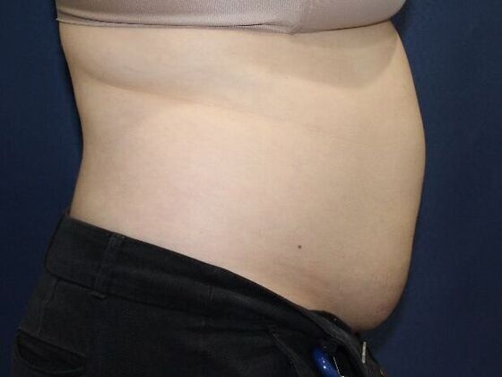 Liposuction: Case 14 - Before