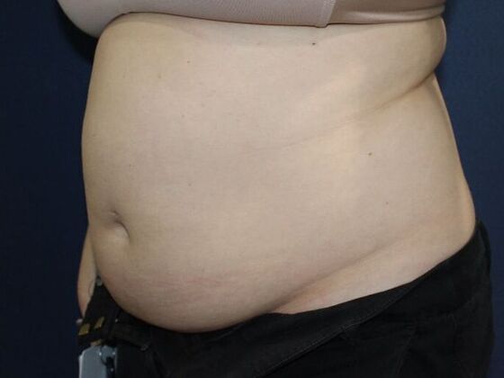 Liposuction: Case 14 - Before