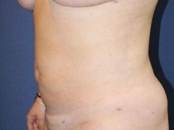 Liposuction: Case 14 - After