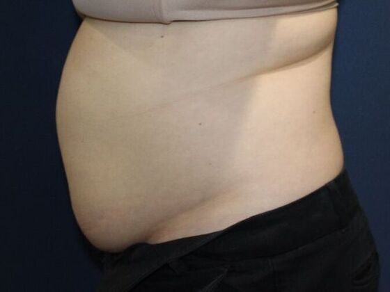 Liposuction: Case 14 - Before