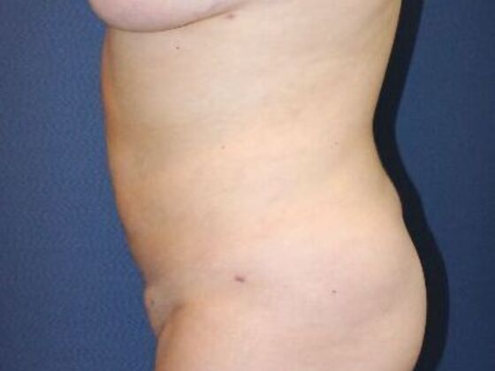 Liposuction: Case 14 - After