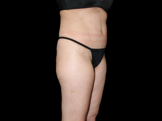 Liposuction Case 15 - Before