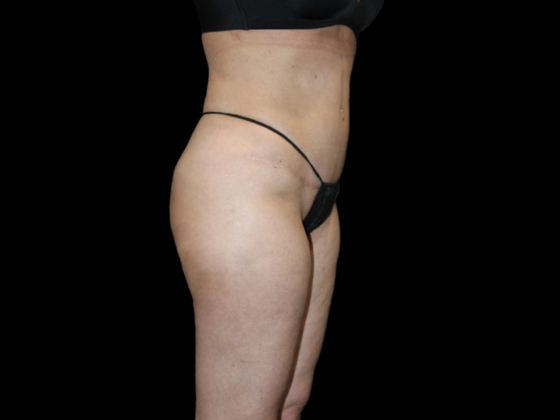 Liposuction Case 15 - After