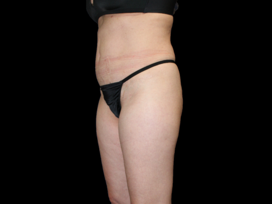 Liposuction: Case 15 - Before