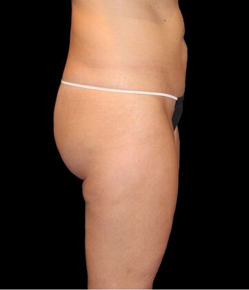 Liposuction: Case 16 - Before