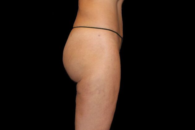 Liposuction: Case 16 - After