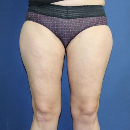 Liposuction Case 17 - After