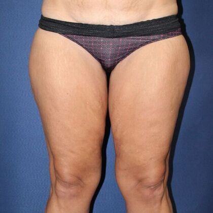 Liposuction Case 17 - Before