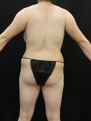 Liposuction Case 18 - After