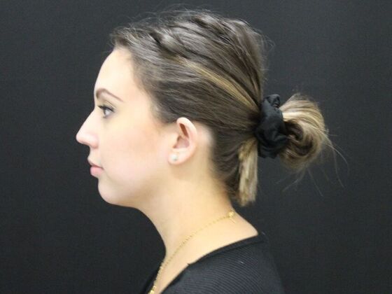 Otoplasty: Case 2 - Before