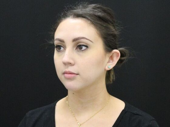 Otoplasty: Case 2 - Before