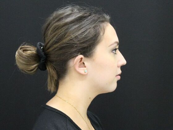 Otoplasty: Case 2 - Before