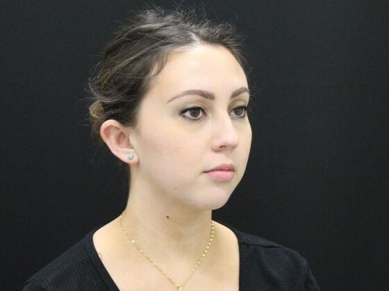 Otoplasty: Case 2 - Before