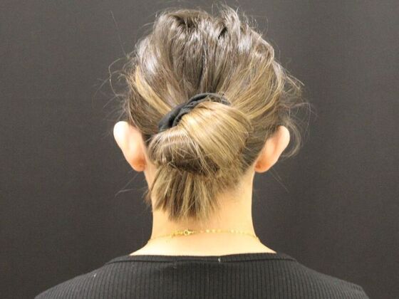 Otoplasty: Case 2 - Before