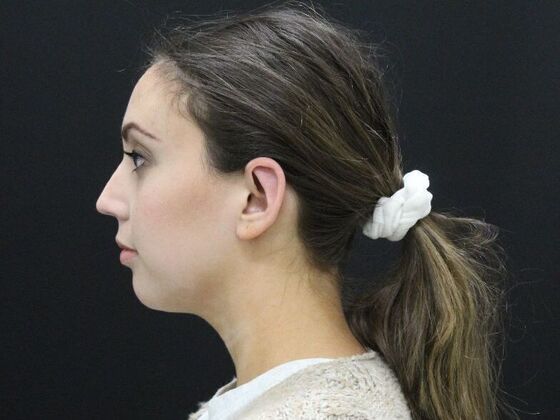 Otoplasty: Case 2 - After