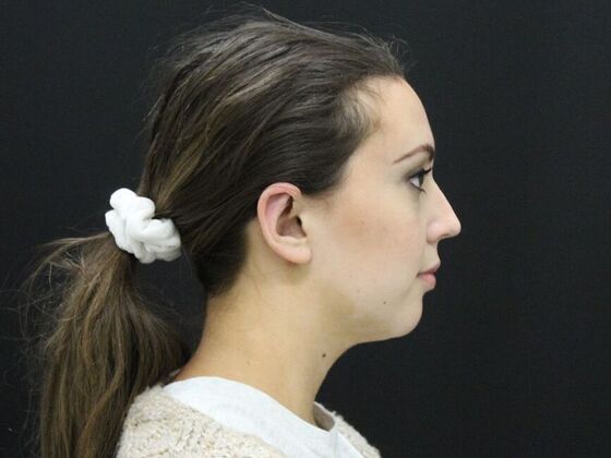 Otoplasty: Case 2 - After