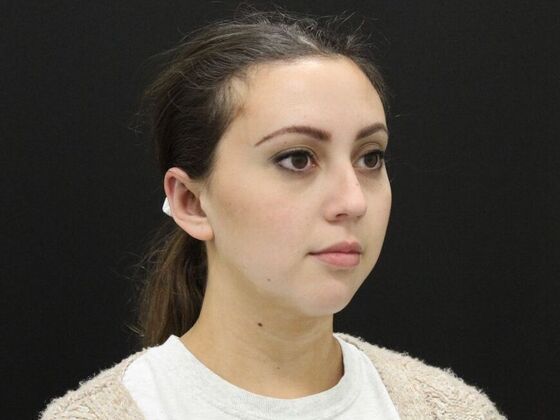 Otoplasty: Case 2 - After