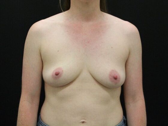 Breast Augmentation Case 15 - Before