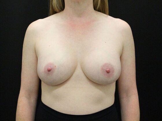 Breast Augmentation Case 15 - After
