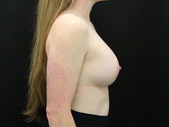 Breast Augmentation: Case 15 - After