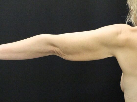 Arm Lift & Reduction: Case 5 - Before