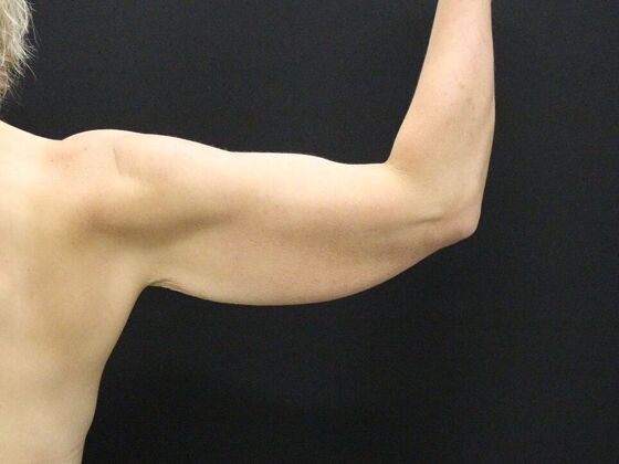 Arm Lift & Reduction: Case 5 - Before