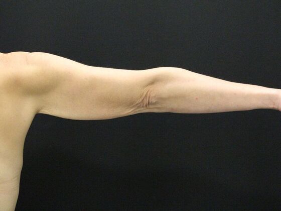 Arm Lift & Reduction: Case 5 - Before