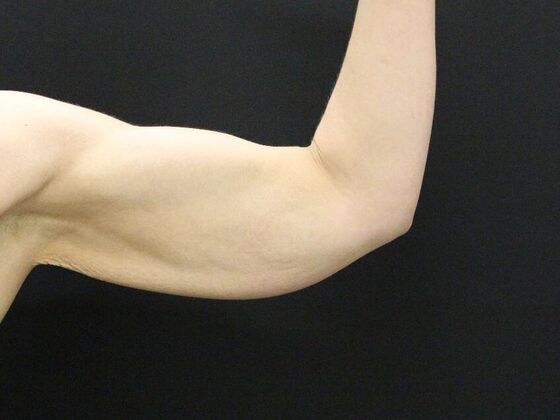 Arm Lift & Reduction: Case 5 - Before