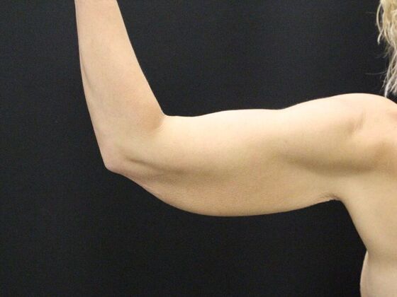 Arm Lift & Reduction: Case 5 - Before
