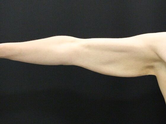 Arm Lift & Reduction: Case 5 - Before