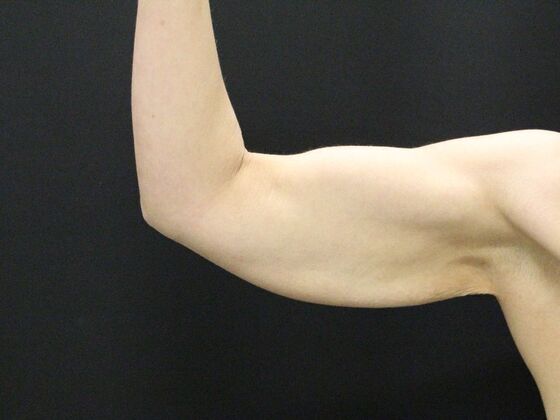 Arm Lift & Reduction Case 5 - Before