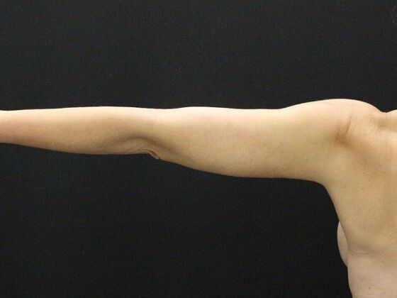 Arm Lift & Reduction: Case 5 - After