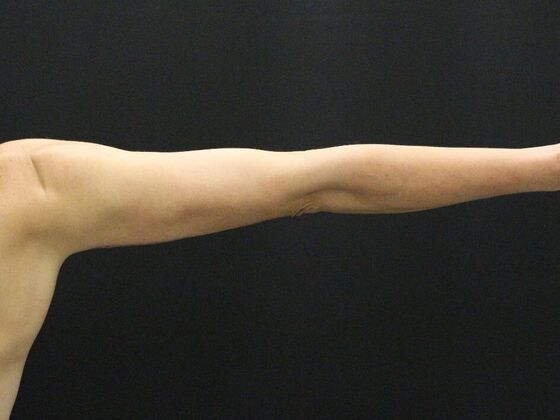 Arm Lift & Reduction: Case 5 - After