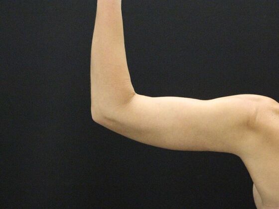 Arm Lift & Reduction: Case 5 - After