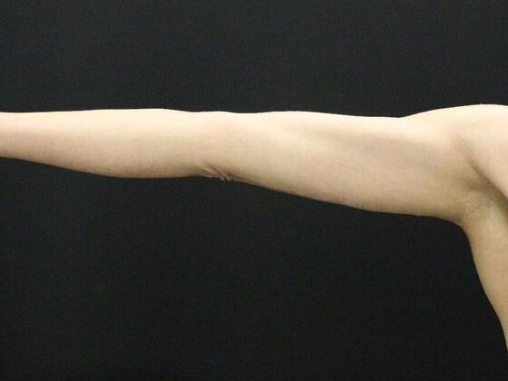 Arm Lift & Reduction: Case 5 - After