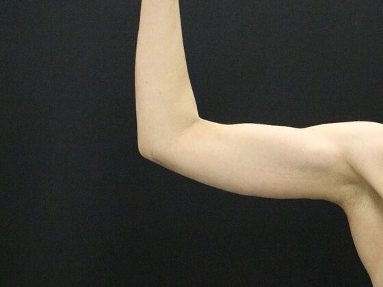 Arm Lift & Reduction Case 5 - After