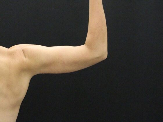 Arm Lift & Reduction: Case 5 - After