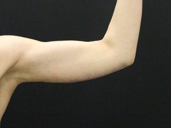 Arm Lift & Reduction: Case 5 - After