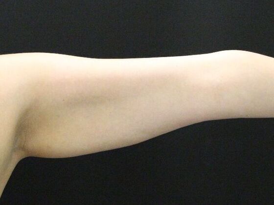 Arm Lift & Reduction: Case 6 - Before